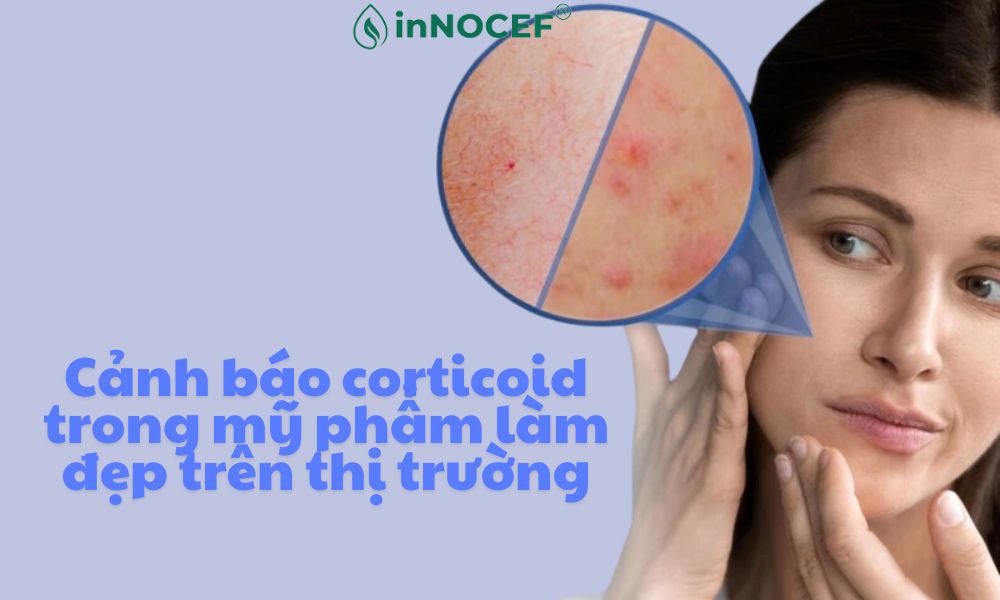 Cảnh báo corticoid trong mỹ phẩm hiện nay