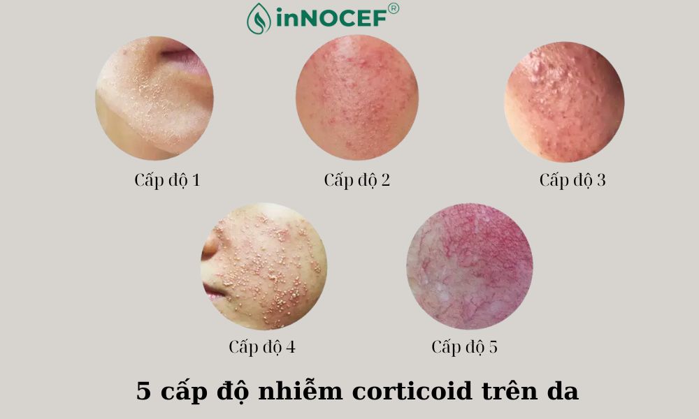 Tác hại khi dùng corticoid trong mỹ phẩm làm đẹp